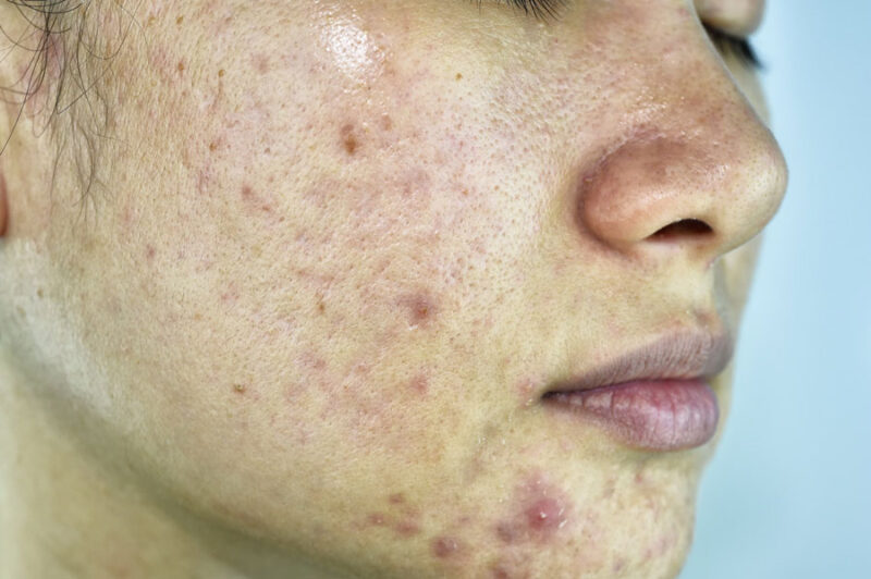 acne-scars-faciem-dermatology-clinic