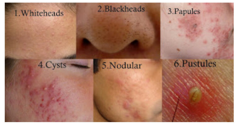 acne-faciem-dermatology-clinic