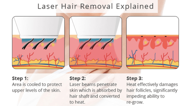 best laser hair remover