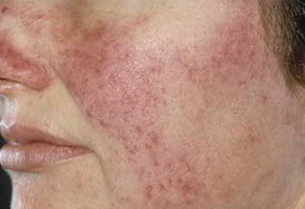 Rosacea | Faciem Dermatology Clinic