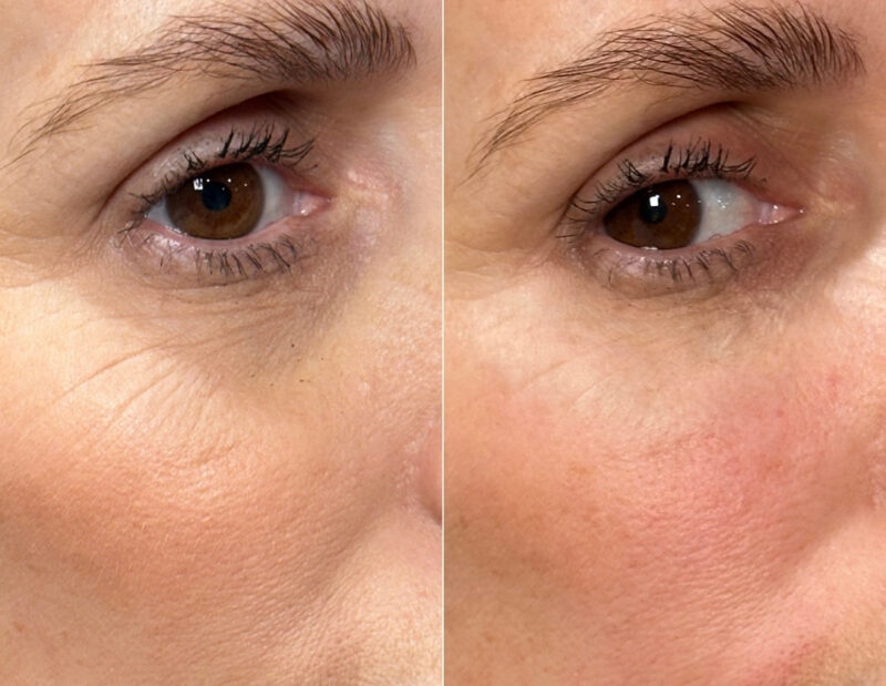 Before & afters 2024 - Ameela Rejuvenation ( first treatment) (3)